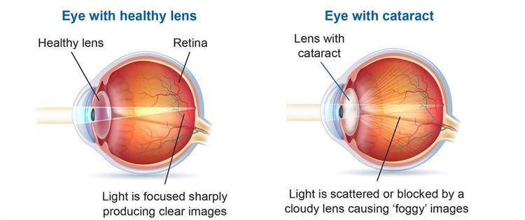 common eye diseases