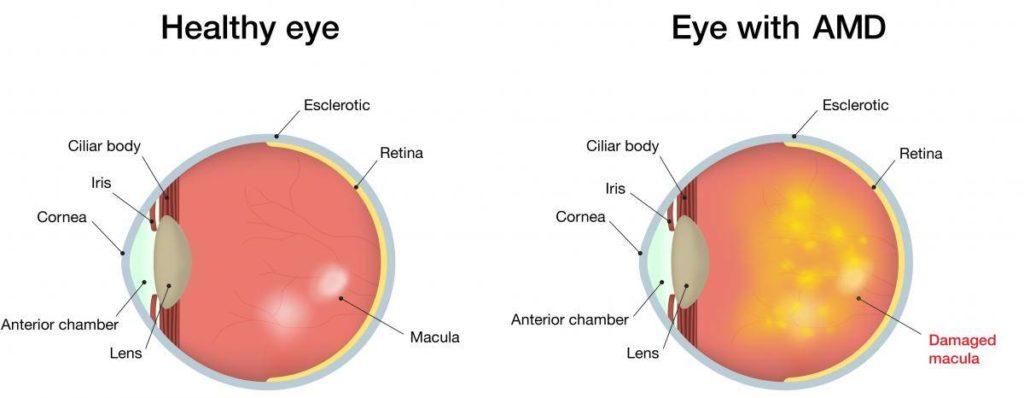common eye diseases